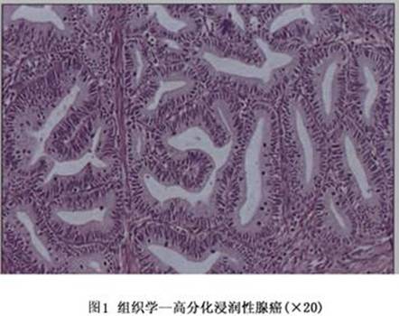 宫颈腺癌(妇科疾病)
